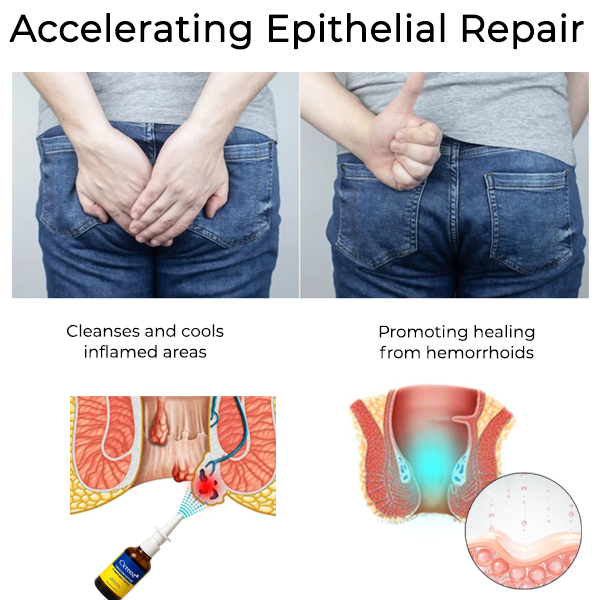 Cvreoz® Bylinný sprej na liečbu hemoroidov v análnom spreji