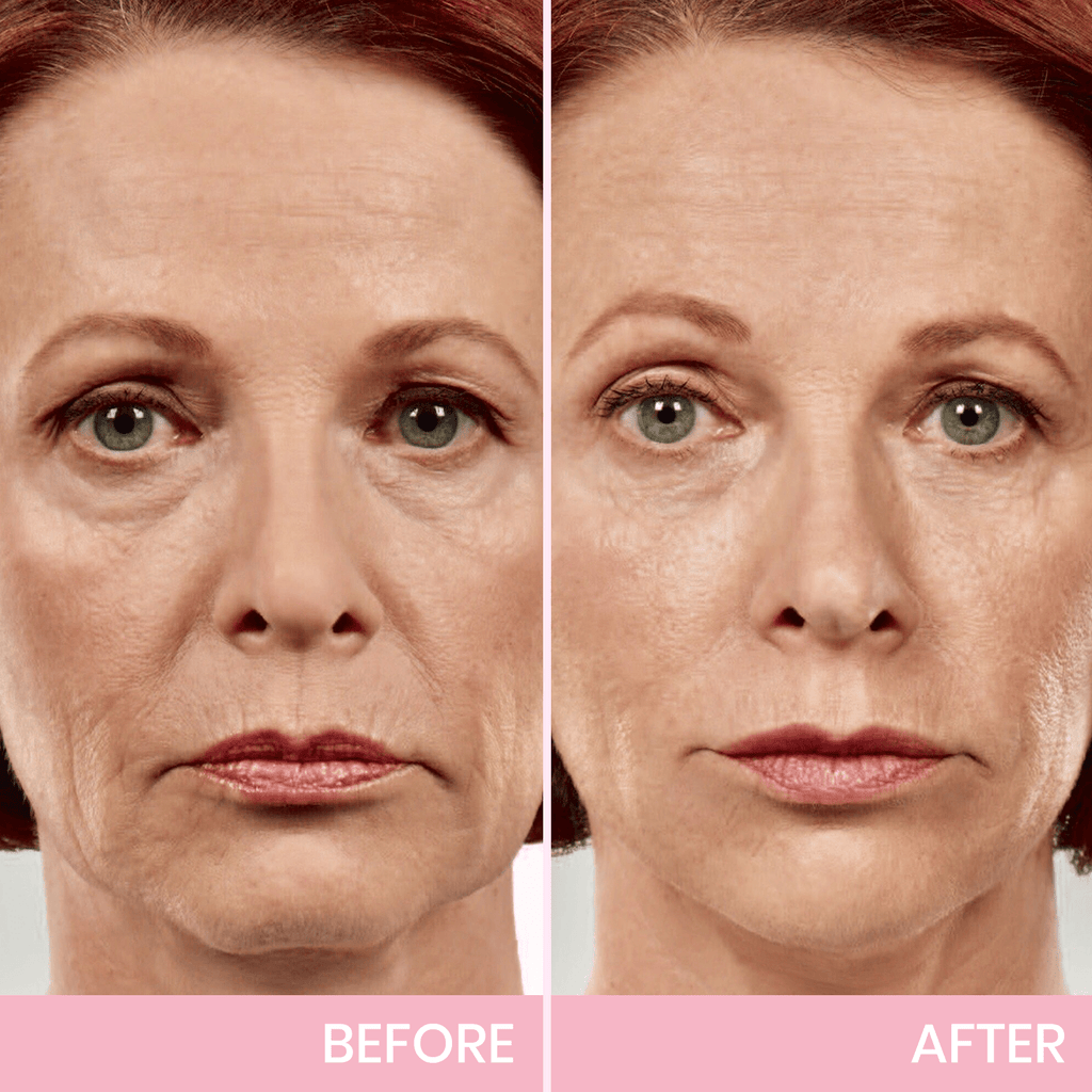 💖🎁Posledný deň so zľavou 50 % – neviditeľná lepiaca páska Aweiya™ V-Face Lifting